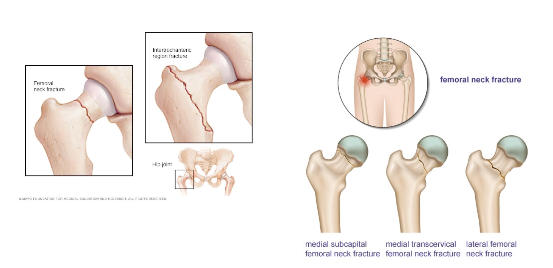 An image from the Bang Personal Training blog post “How (Not) to Break a Hip”